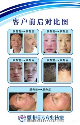 【香港瑤芳9點9元祛痘團購】_泉州國貿(mào)商城香港瑤芳專業(yè)祛痘團購10元_糯米麗人團購